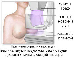 маммограмма